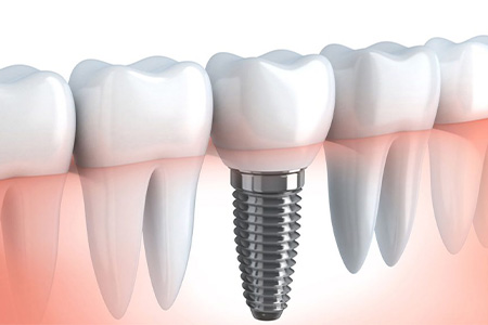 Implantodontia - Clínica Renovi Odontologia