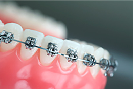 Ortodontia - Clínica Renovi Odontologia