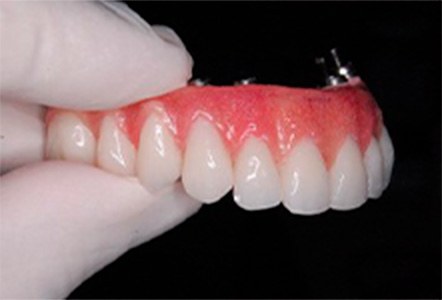 Reabilitação Oral - Clínica Renovi Odontologia